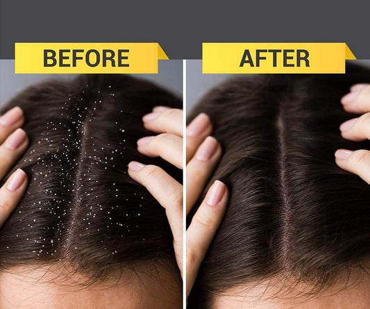 001 – Topical Anti-Dandruff & Antifungal Shampoo